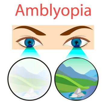 forms-of-amblyopia