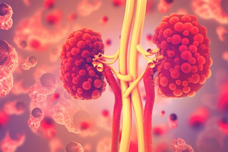 DNA-PKcs is a newly discovered target for the treatment of chronic kidney disease