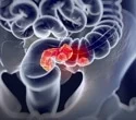 Why are young individuals developing colon cancer at higher rates?
